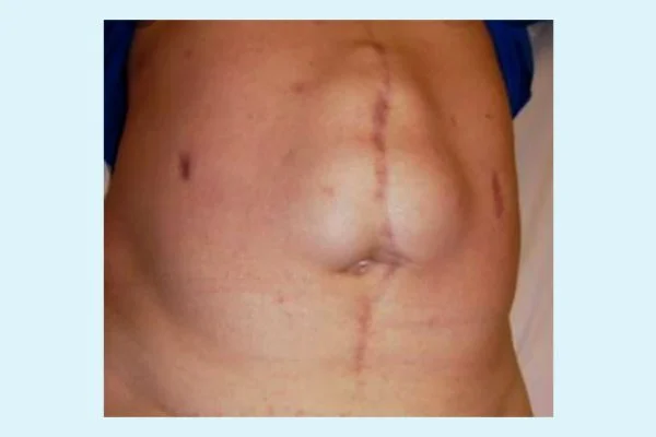 Abdominal Wall Reconstruction Surgery